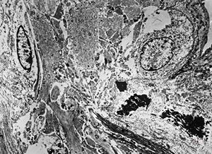 F,17y. | dystrophic calcification in a glial scar